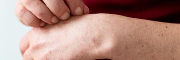 Зарегистрировано еще два случая заболевания корью