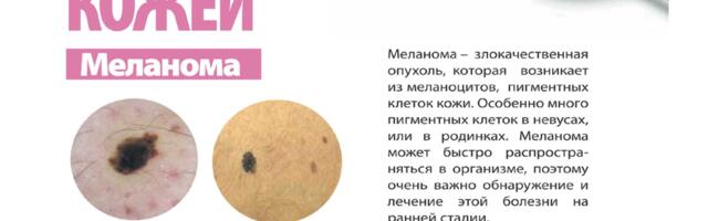 На что нужно постоянно обращать внимание при родинках?