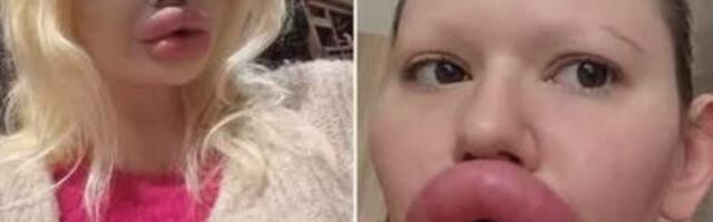 Женщина с «самыми большими губами в мире» вынуждена «страдать», поскольку врачи «не хотят ее лечить»