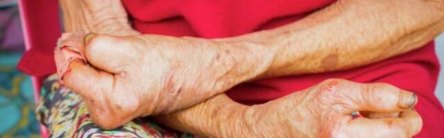 В Европу вернулась страшная болезнь — проказа