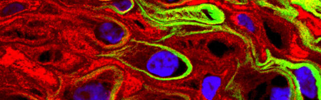 Институт развития здоровья: тип ВПЧ и возраст женщины влияют на риск рака шейки матки