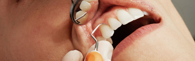 Плохая гигиена полости рта может повысить риск деменции