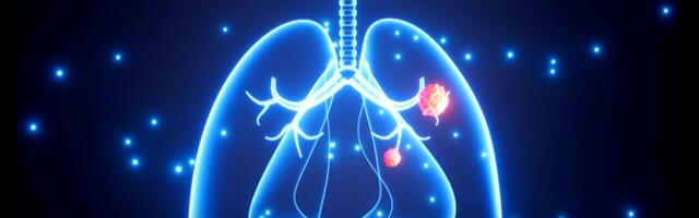 "Impulss": участие в пробном проекте скрининга рака легких подарило Эве и Хелле вторую жизнь