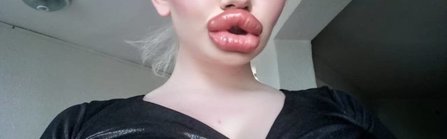 «Мне очень больно есть»: как выглядит девушка с самыми большими губами