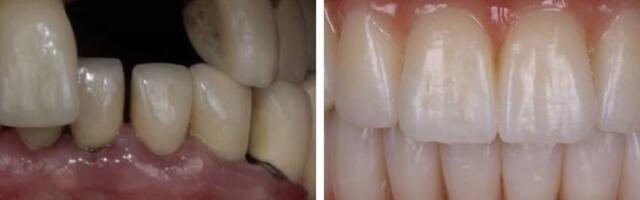 Миф или правда? | Вместо удаленного зуба можно в тот же день установить новый