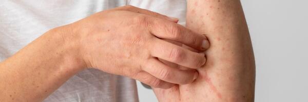 Зарегистрирована первая вспышка кори с 2018 года