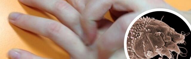 Департамент здоровья: рост распространения чесотки в Эстонии не наблюдается