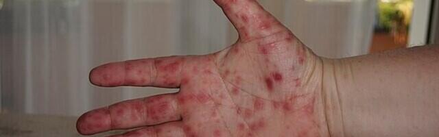 Ранняя осенняя вспышка энтеровирусов сопровождается волдырями и отслоением ногтей