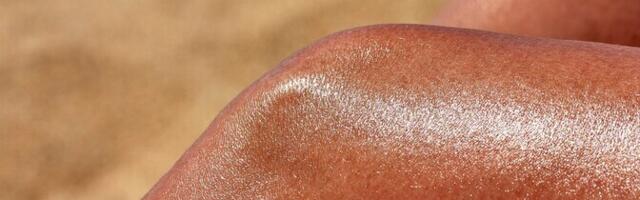 Онколог: развитию меланомы способствуют солнечные ожоги, полученные в детстве и юности