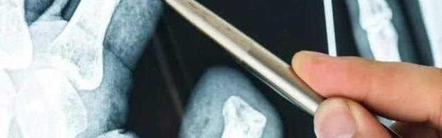 Китайские ученые создали гель, заживляющий переломы за 3 минуты