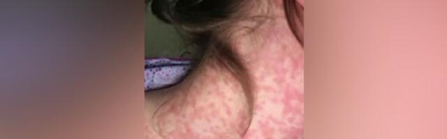 Число заболевших корью в Латвии продолжает расти