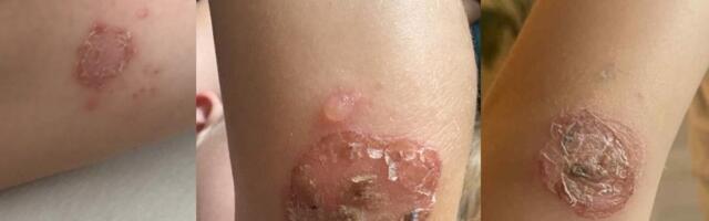 После купания в литовском озере – шокирующие последствия: заразились все дети 