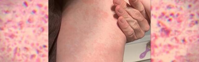 В Латвии зафиксирована вспышка кори