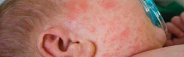 Число заболевших корью в Латвии выросло до 42