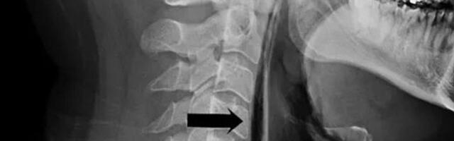 Правдива ли новость про жителя Карелии, который разорвал глотку, пока пытался не чихнуть?