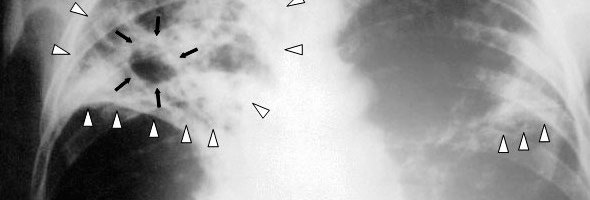 Ограничения из-за коронавируса могут привести к гибели 1,4 млн человек от туберкулеза